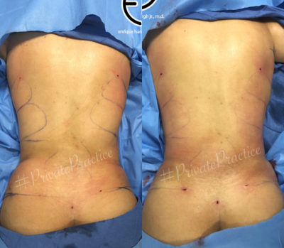 Liposuction before and after photo