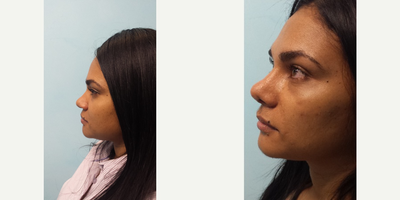 Rhinoplasty before and after photo