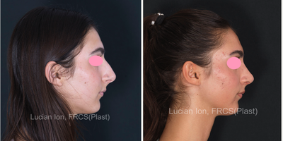 Rhinoplasty before and after photo