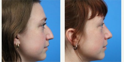 Rhinoplasty before and after photo