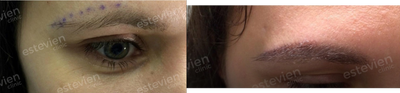Eyebrow Transplant before and after photo