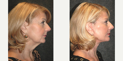Facelift before and after photo