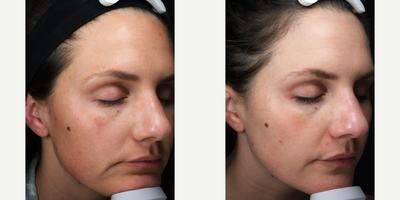 Halo Laser before and after photo
