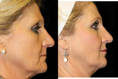 Liquid Facelift before and after photo