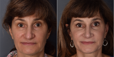 Rhinoplasty before and after photo