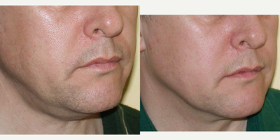 Thermage before and after photo