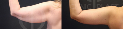 Arm Lift before and after photo