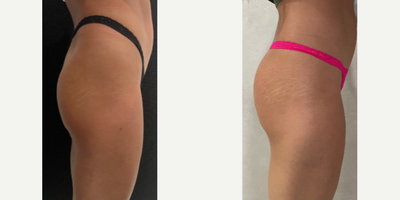 Bellafill before and after photo