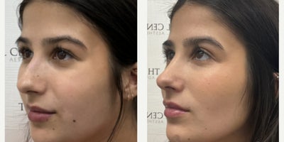 Buccal Fat Removal before and after photo