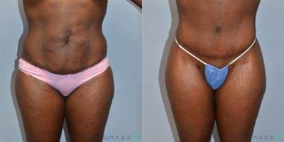 Liposuction before and after photo