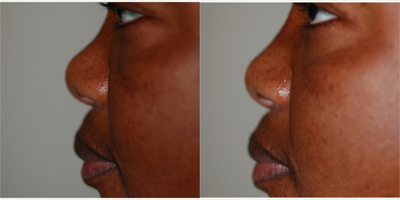 Nonsurgical Nose Job before and after photo
