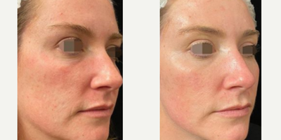 Opus Plasma before and after photo
