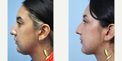 Facelift before and after photo