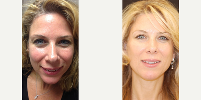 Liquid Facelift before and after photo