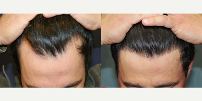 NeoGraft before and after photo