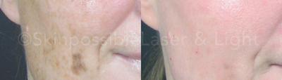 ActiveFX before and after photo