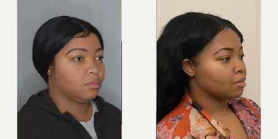 Buccal Fat Removal before and after photo