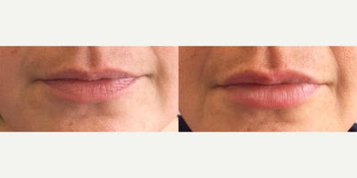 Lip Fillers before and after photo