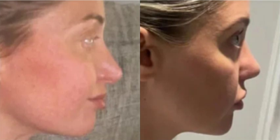 Revision Rhinoplasty before and after photo