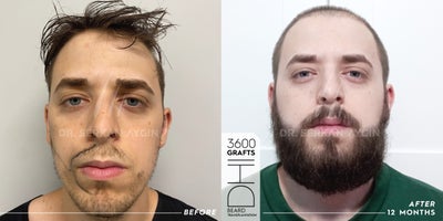 Beard Transplant before and after photo