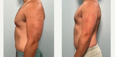 Gynecomastia Surgery before and after photo