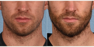 Hair Transplant before and after photo