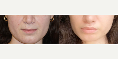 Lip Lift before and after photo