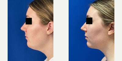 Liposuction before and after photo
