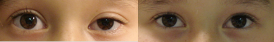 Ptosis Surgery before and after photo