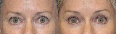 Brow Lift before and after photo