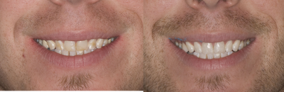 Dental Bonding before and after photo