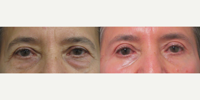 Eyelid Surgery before and after photo