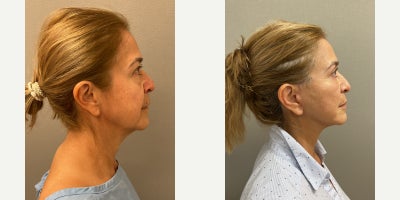 Facelift before and after photo
