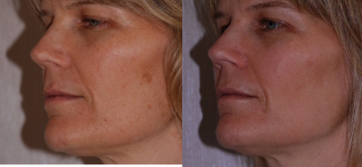 IPL before and after photo