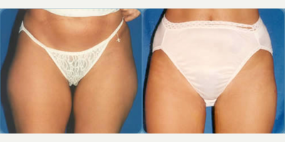 Liposuction before and after photo