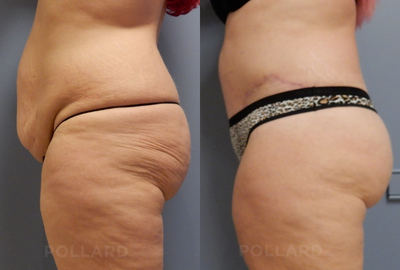 Tummy Tuck before and after photo