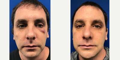 Venus Viva before and after photo