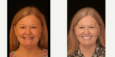 ClearChoice Dental Implants before and after photo