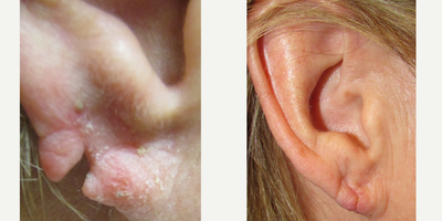 Earlobe Repair before and after photo