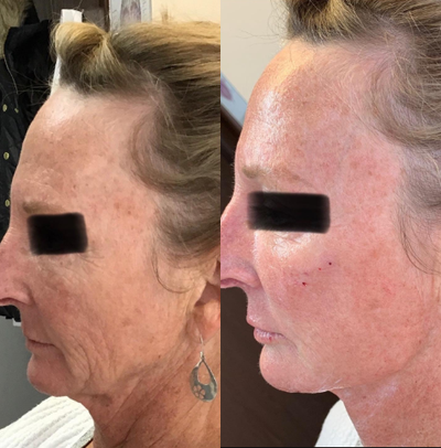 Nonsurgical Facelift before and after photo
