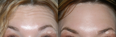 Botox before and after photo