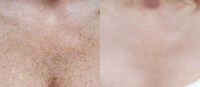 IPL before and after photo
