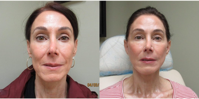 Lower Facelift before and after photo