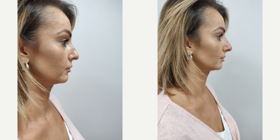 Restylane Defyne before and after photo