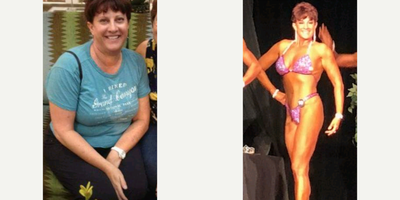 Tummy Tuck before and after photo