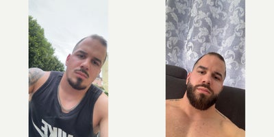 Beard Transplant before and after photo