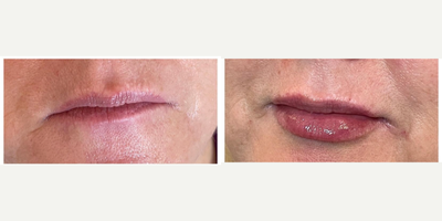 Lip Fillers before and after photo
