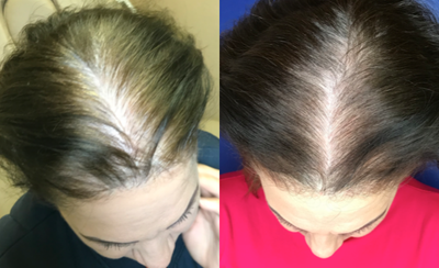 PRP for Hair Loss before and after photo