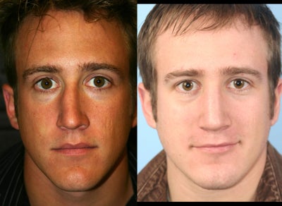 Rhinoplasty before and after photo