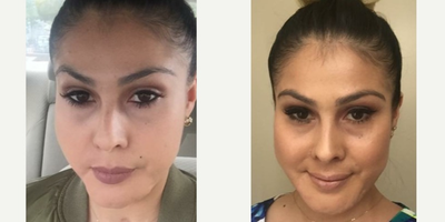 Voluma before and after photo